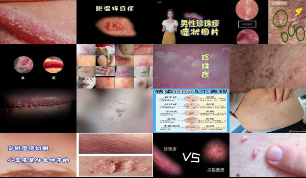 汕头男性*医院哪里比较好 - 汕头男性尖锐初期小丘疹图片