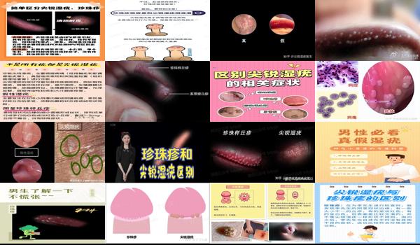 珍珠疹与尖锐湿疹的区别 - 汕头珍珠疹和尖锐的区别图