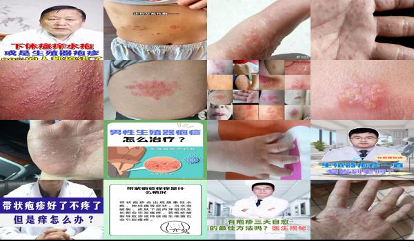 男性疱疹会痒吗? - 汕头男性疱疹会痒吗