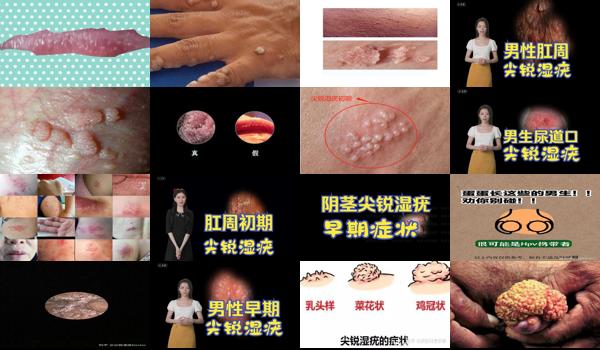 汕头有男性男科医院吗 - 汕头男性尖锐湿尤图症状图片